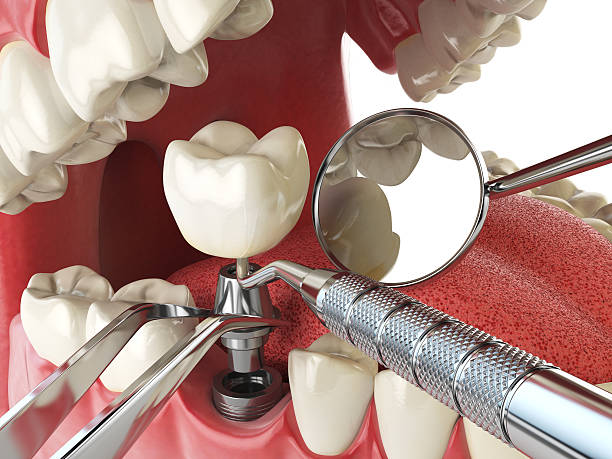 Best Emergency Tooth Extraction in Falmouth, VA